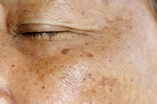 Melasma: como pode surgir e quais são os melhores tratamentos