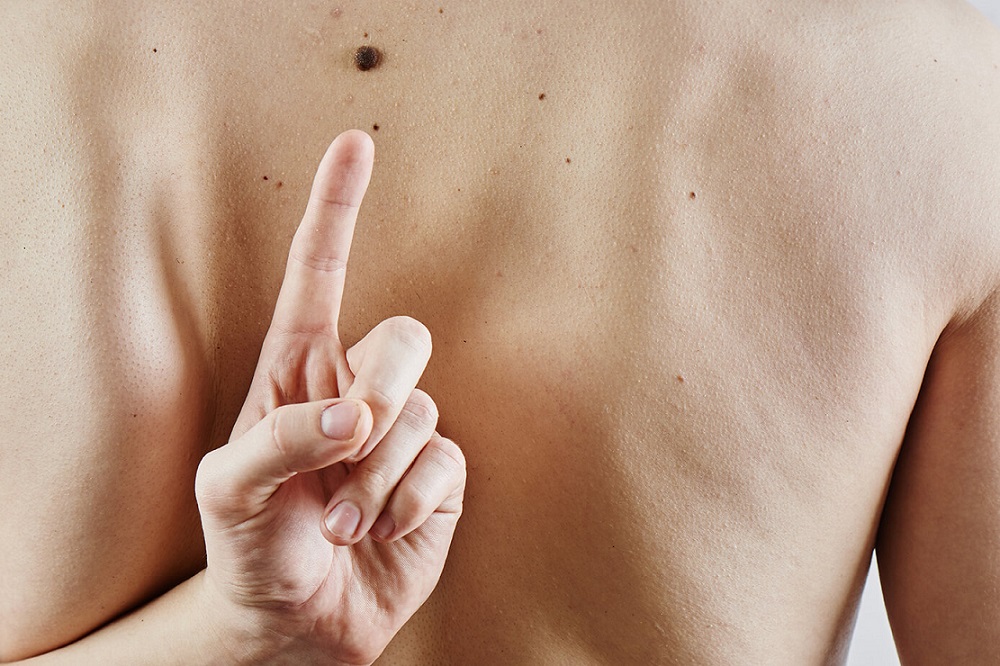 Dezembro Laranja: campanha reforça cuidados contra o câncer de pele