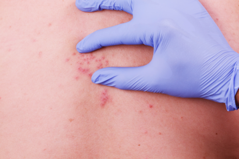 Vírus que causa herpes zóster persiste em quase todos os adultos Vírus que causa herpes zóster persiste em quase todos os adultos